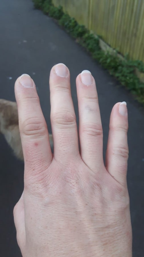 Why Do My Hands Feel Swollen After A Long Walk